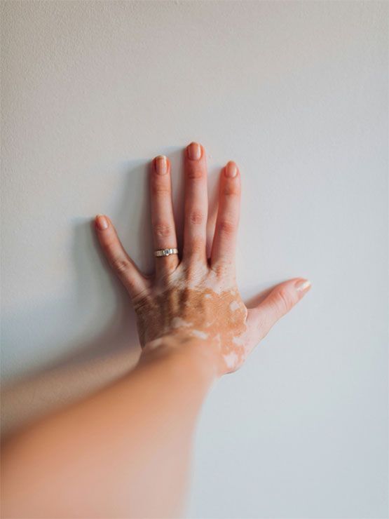 Ekzemerkrankungen, Alopecia Areata, Vitiligo