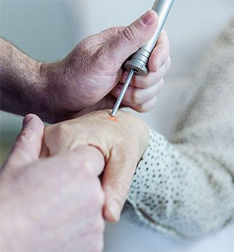 Laserbehandlung Altersfelcken Handrücken
